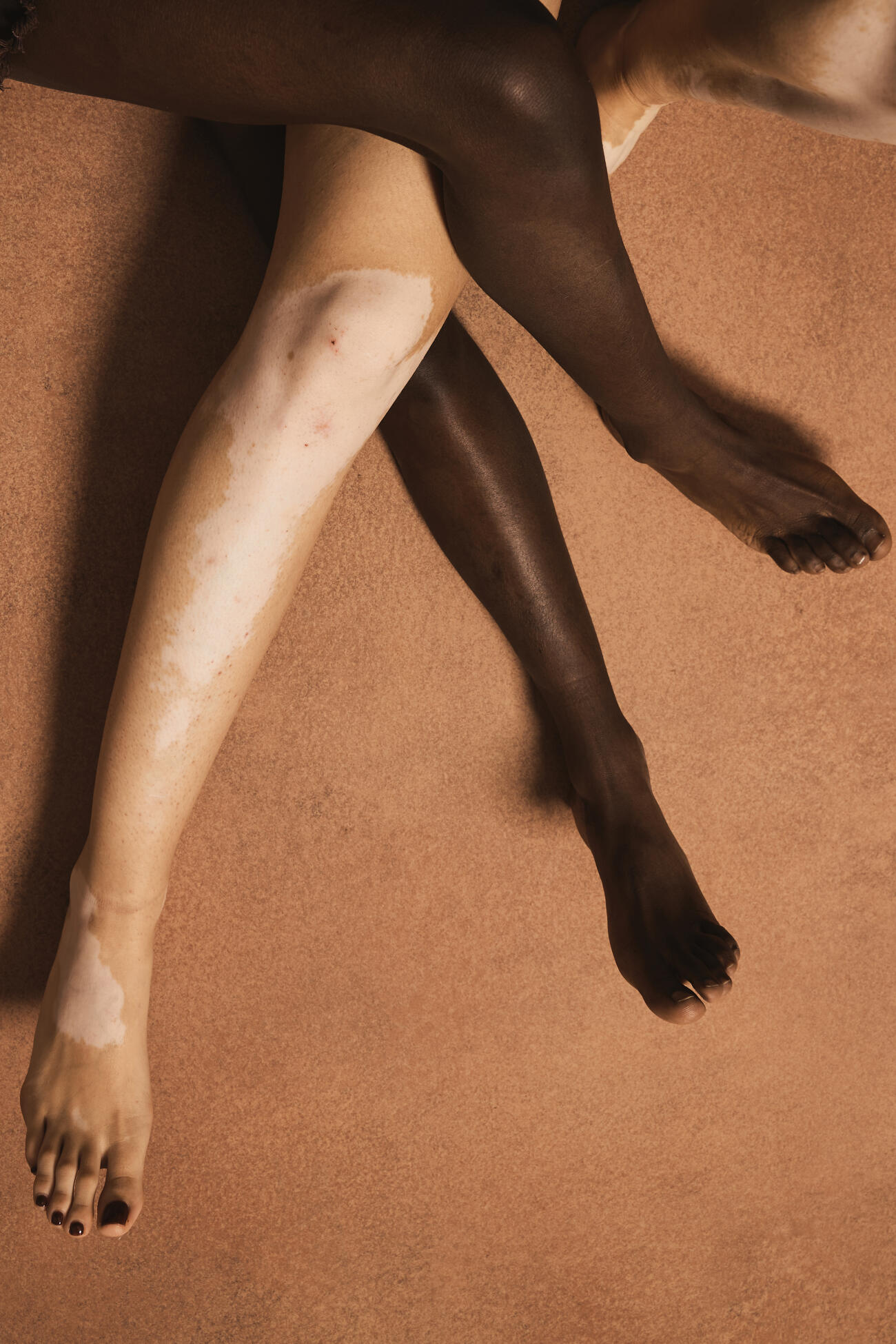 Two individuals' legs with contrasting skin colors and vitiligo are intertwined on a warm brown background, representing diversity, inclusion, and authentic human beauty